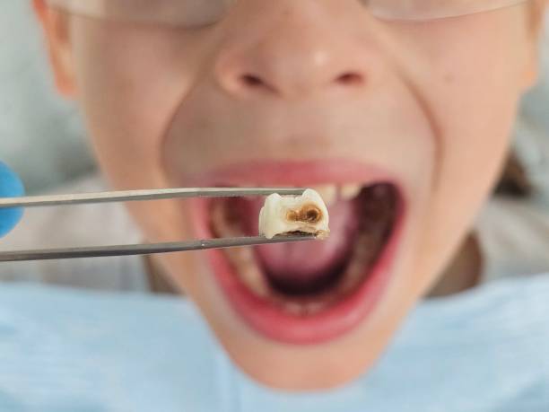 Best Emergency Dentist for Knocked-Out Tooth in Grundy, VA