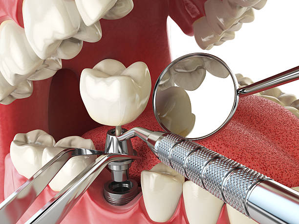 Best Emergency Dentist for Lost Fillings or Crowns in Grundy, VA